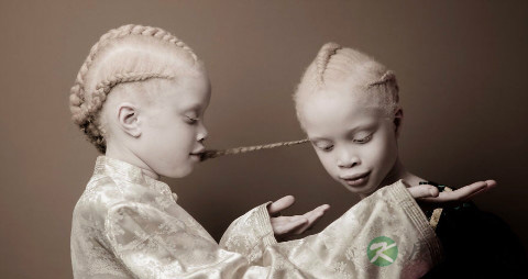 得白化病的概率是多少