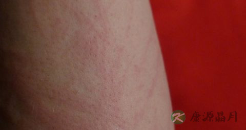 白血病的出血点整齐吗
