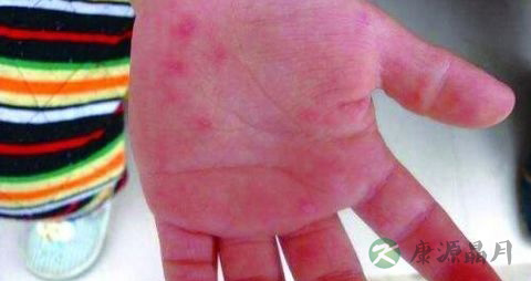 重度手足口病有后遗症吗