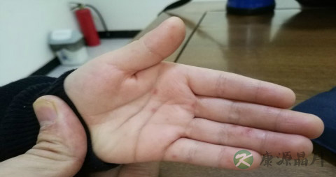 手足口病吃什么菜