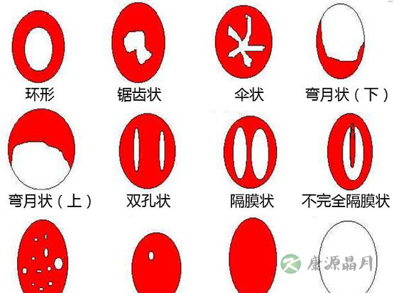 处女膜长什么样_处女膜破了怎么办 处女膜长什么样_处女膜破了怎么办