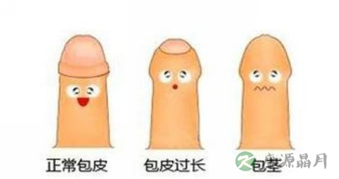 男性包皮过长的判断标准 男性包皮过长的判断标准