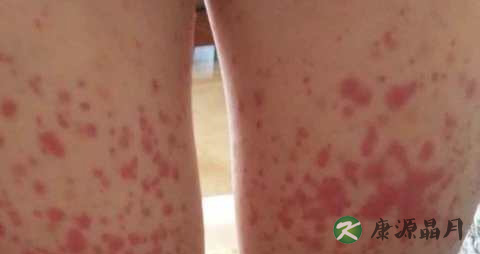 大腿肚内侧红点是什么 大腿肚内侧红点是什么