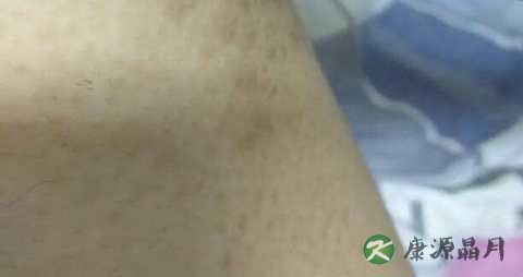 大腿肚内侧红点是什么 大腿肚内侧红点是什么