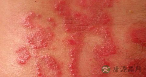 成人患上牛皮癣怎么治疗 成人患上牛皮癣怎么治疗