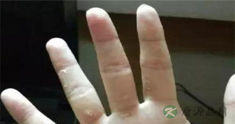 治疗手廯的药草 治疗手廯的药草