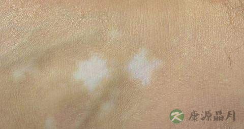 白斑病治疗的正规方法 白斑病治疗的正规方法
