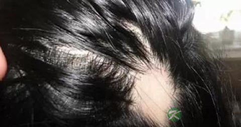 治疗斑秃的偏方 治疗斑秃的偏方