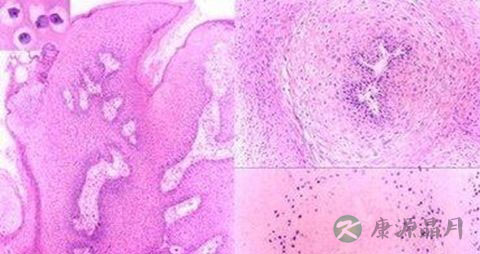 偏方治疗生殖器疱疹 偏方治疗生殖器疱疹