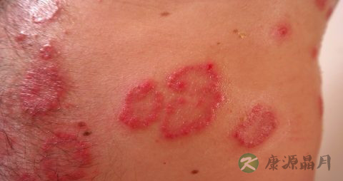 尖锐湿疹早期会疼会痒吗 尖锐湿疹早期会疼会痒吗