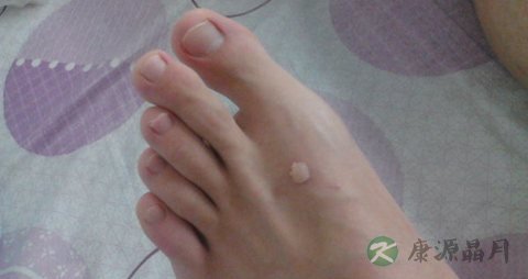脚上长鸡眼是什么 脚上长鸡眼是什么