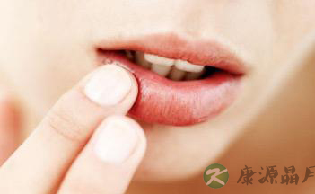 防治嘴唇干裂 护好健脾是关键 防治嘴唇干裂 护好健脾是关键