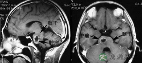 中国"小鸟叔"病逝 恶性肿瘤成儿童第二大死因 中国"小鸟叔"病逝 恶性肿瘤成儿童第二大死因