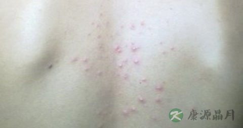 后背长粉刺原因引起的 后背长粉刺原因引起的