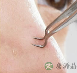 让你黑头逐渐变少的法宝 让你黑头逐渐变少的法宝