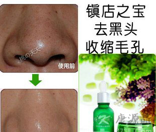 去黑头最有效的产品 去黑头最有效的产品
