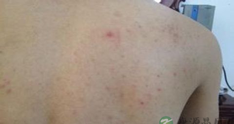 后背长粉刺怎么去除 后背长粉刺怎么去除