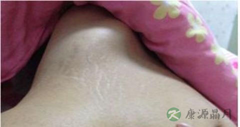 怎么消除产后妊娠纹