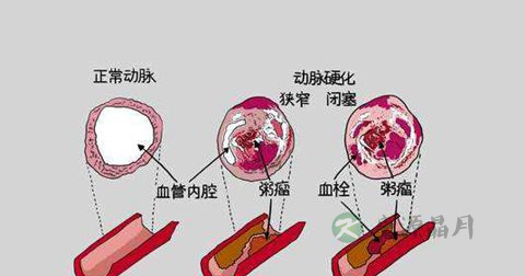 冠心病