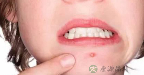 下巴长痘 下巴长痘
