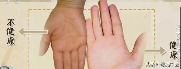 手是健康的镜子，10种常见病，从手上就能看出来