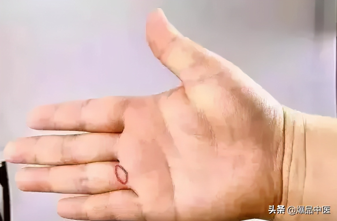 一个奇穴,专治各种“不通”