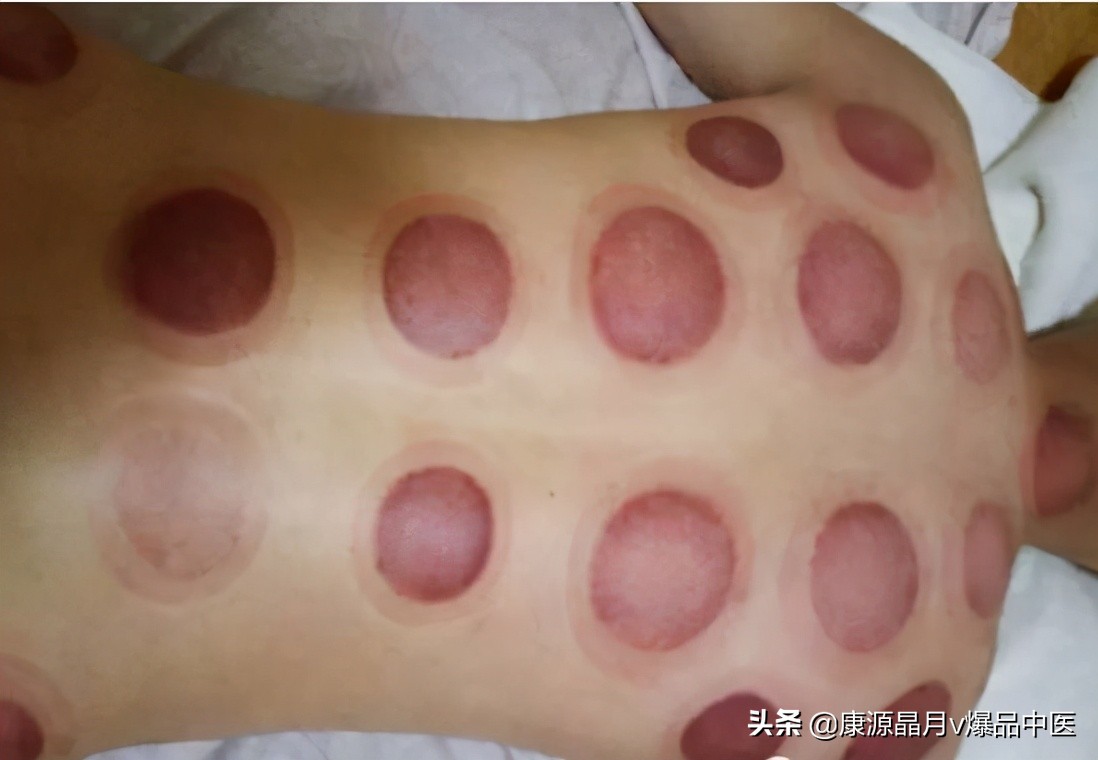 拔罐方法不对=缩短生命,中医提醒,拔火罐警惕四个禁忌