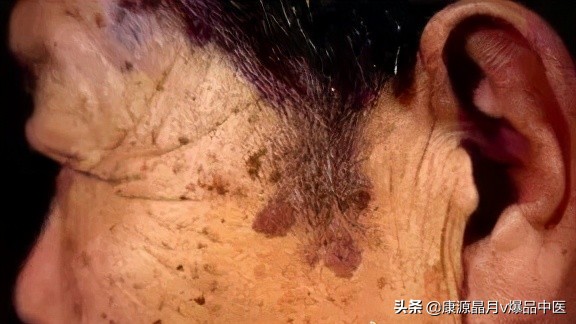 警惕!内脏有癌,皮肤先知