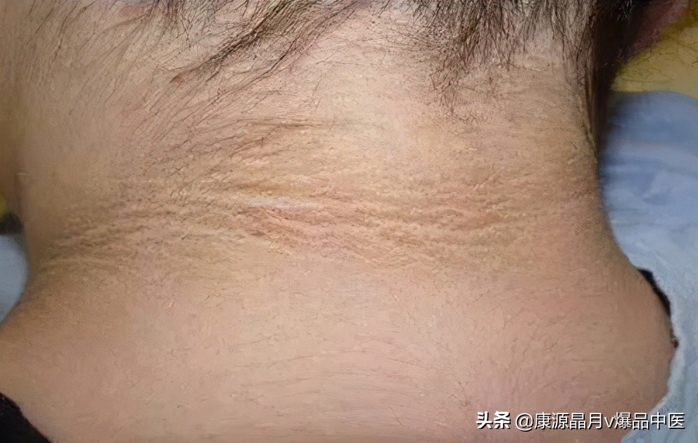 警惕!内脏有癌,皮肤先知