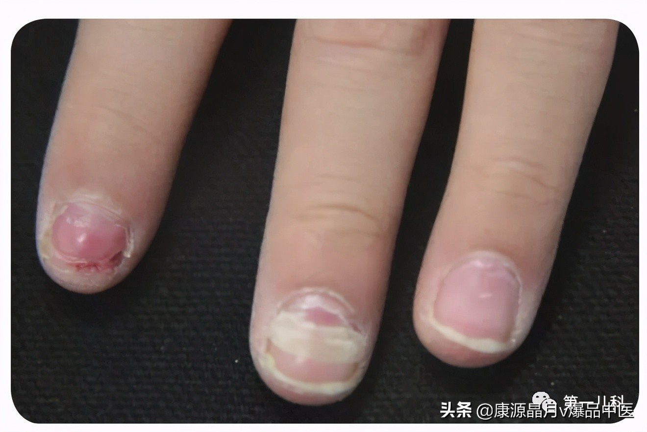 超全图解!手足口病、猩红热、幼儿急疹、水痘.如何区别处理?