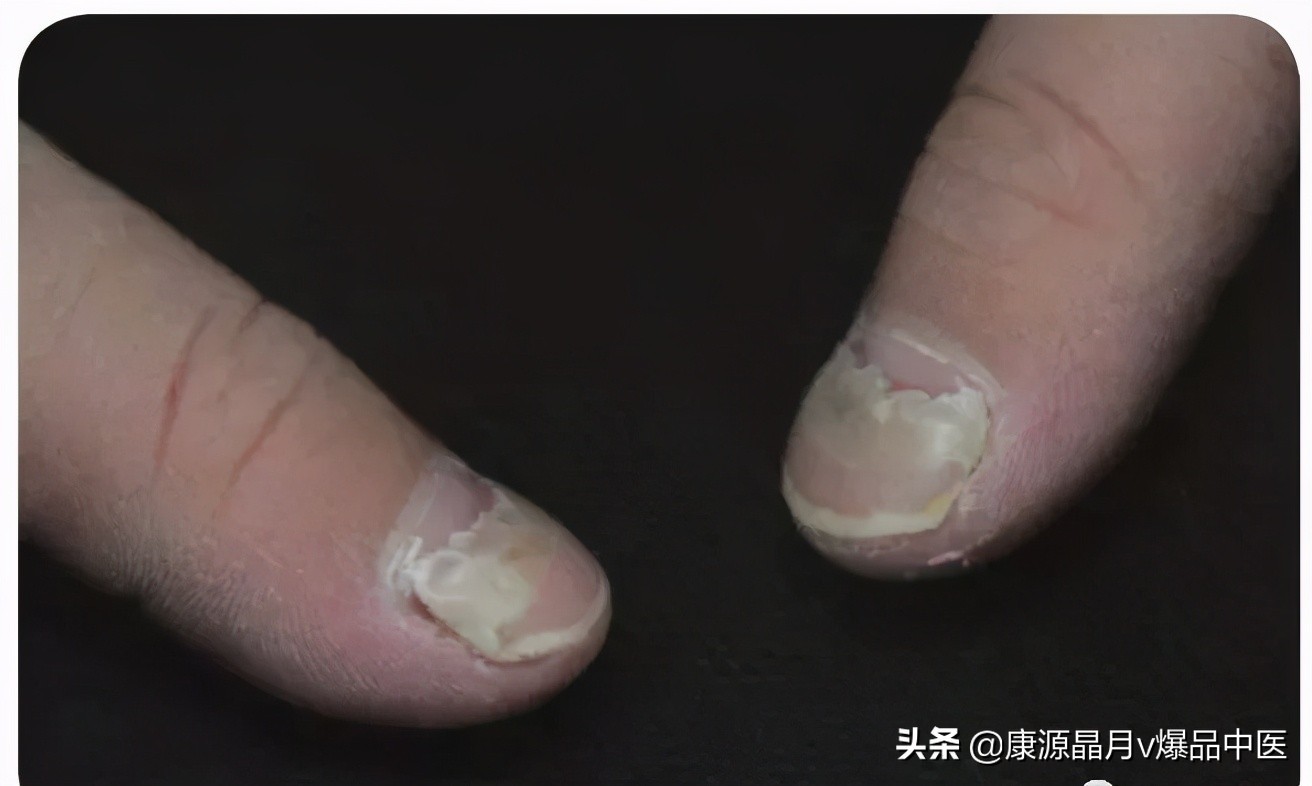 超全图解!手足口病、猩红热、幼儿急疹、水痘.如何区别处理?