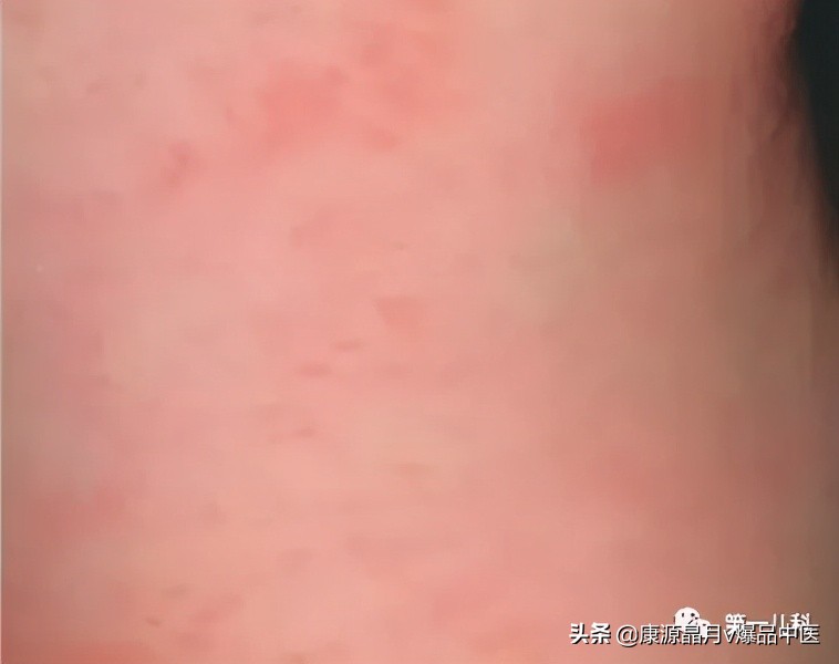 超全图解!手足口病、猩红热、幼儿急疹、水痘.如何区别处理?