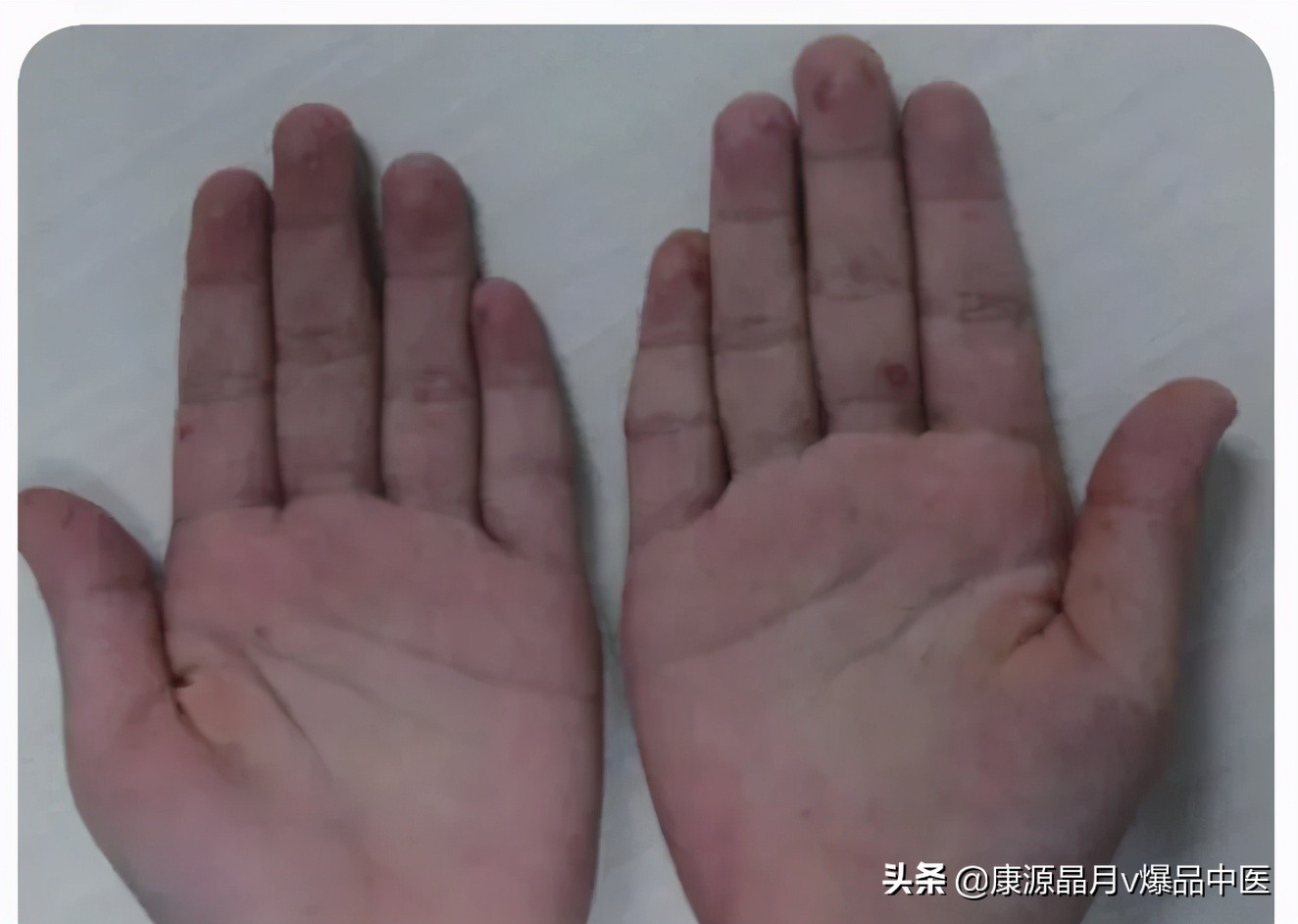 超全图解!手足口病、猩红热、幼儿急疹、水痘.如何区别处理?