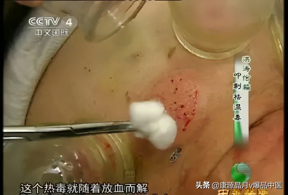治疗“蛇盘腰”民间中医绝技!(收藏备用)