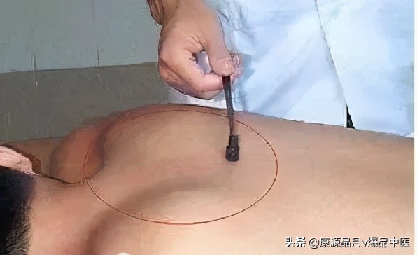 治疗“蛇盘腰”民间中医绝技!(收藏备用)