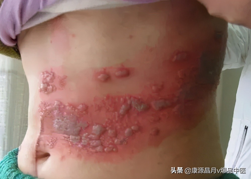 治疗“蛇盘腰”民间中医绝技!(收藏备用)
