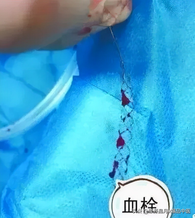 脚上有个“化血栓开关”,打开它,就可清血管、防血栓