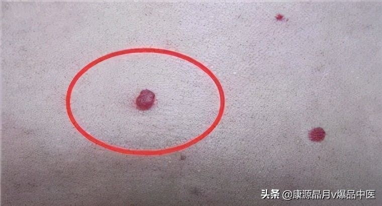 血痣,肝胆病变的前兆?!真的要注意
